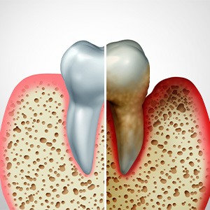 Diagram of healthy gums and gum with periodontal disease