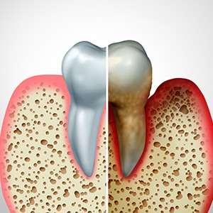 illustration of healthy gums and gum disease