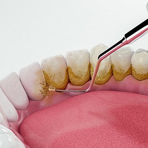 closeup illustration of deep teeth cleaning