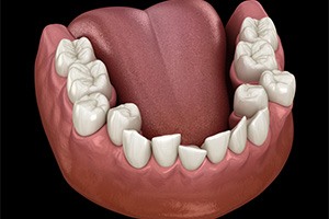 a computer illustration depicting crowded teeth