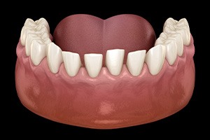 a computer illustration showing misspaced teeth