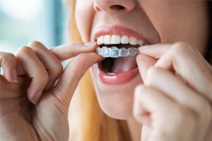 woman putting her Invisalign aligner in her mouth 