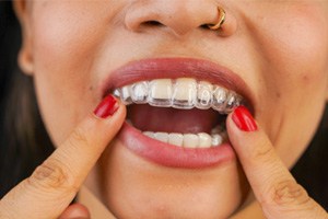 closeup of a woman putting your aligners in that are discreet 