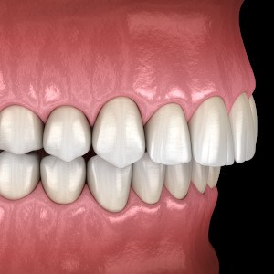 diagram of an overbite