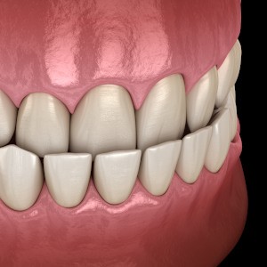 diagram of an underbite