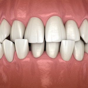 diagram of a crossbite