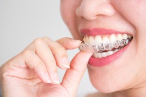 closeup of a person putting in an Invisalign aligner