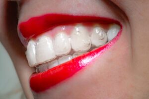 closeup of a mouth with Invisalign aligners in